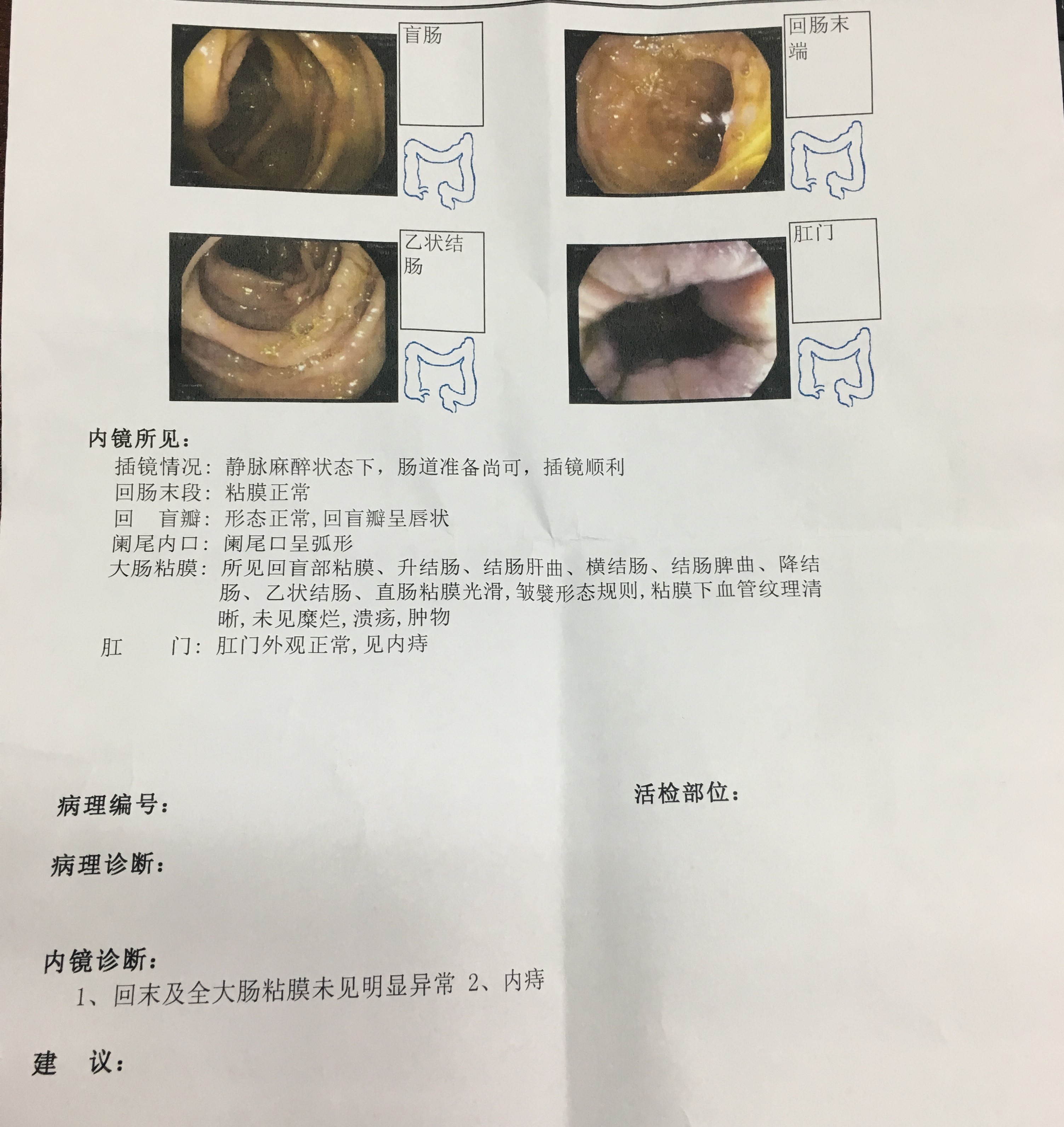 肠镜检查有痔疮怎么弄,做肠镜有痔疮咋办