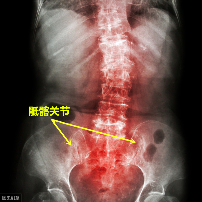 强直性脊柱炎建议生孩子吗,强直性脊柱炎会危害下一代吗