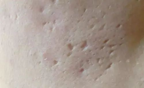 非剥落式点阵激光治疗痘坑,多浅的凹坑可以用点阵激光