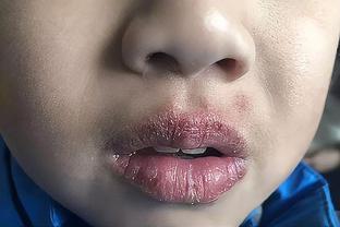 小孩嘴唇干裂出血怎么快速恢复,小孩嘴唇干裂起皮最快治好的方法