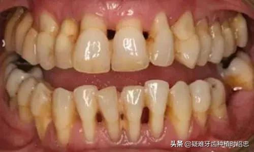 牙周炎导致牙齿松动严重怎么办,重度牙周炎导致牙齿松动