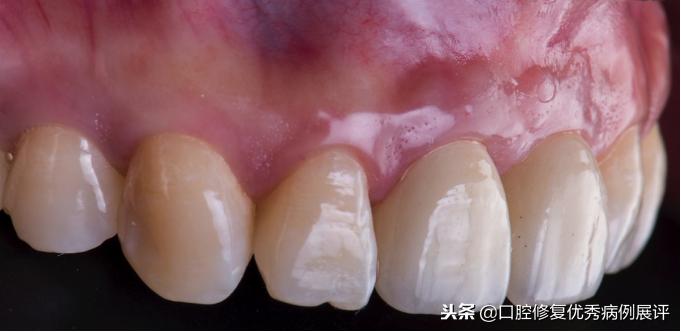 展评优秀病例赏析|Asc全瓷角度基台一体冠进行种植前牙美学修复