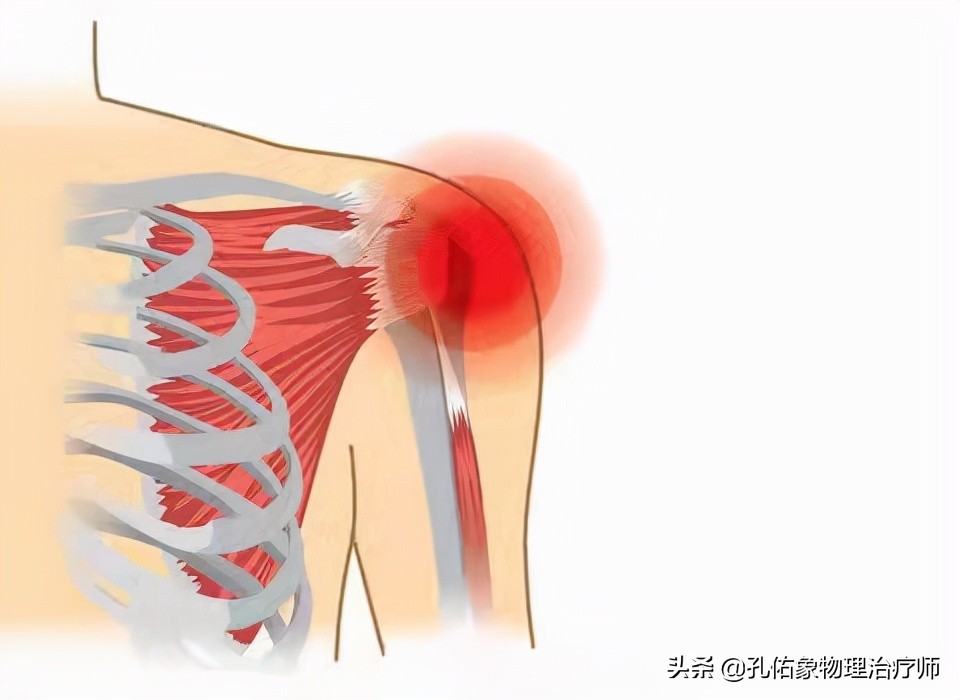 肩膀痛不知什么原因,教你一个动作解决肩膀疼痛
