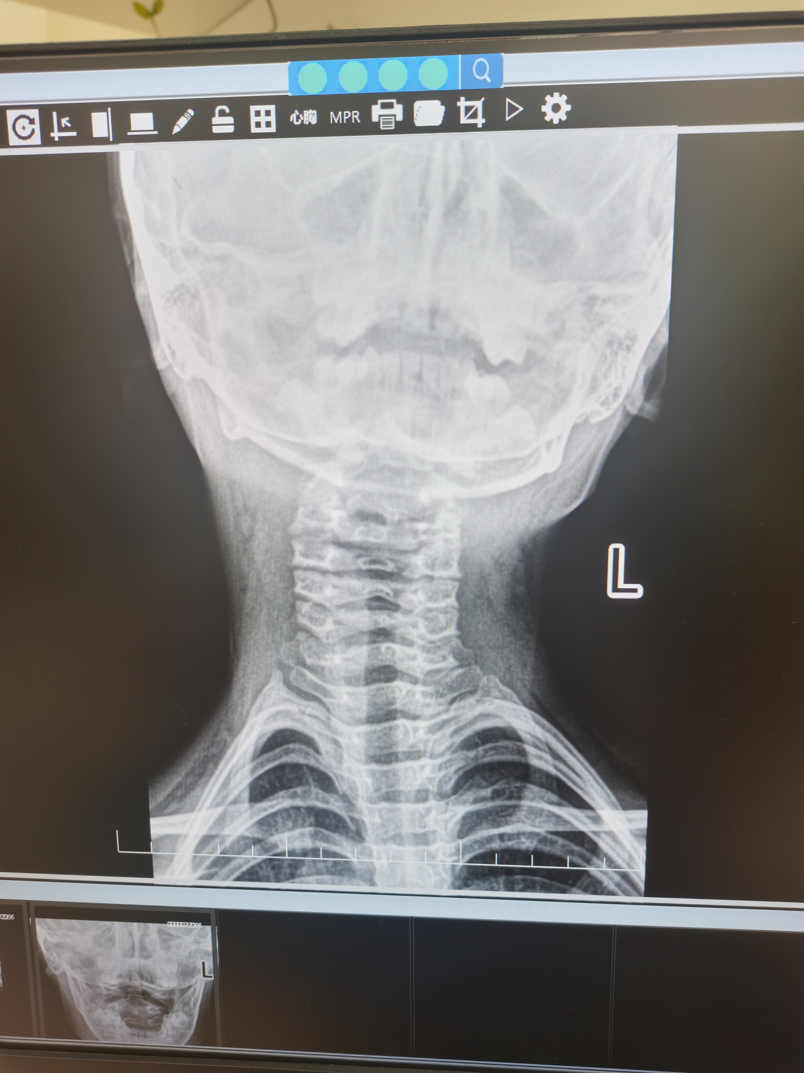 小儿落枕,小儿落枕解决办法图解