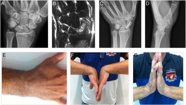 中医治疗腕舟骨骨折,经皮钢板治疗胫骨骨折