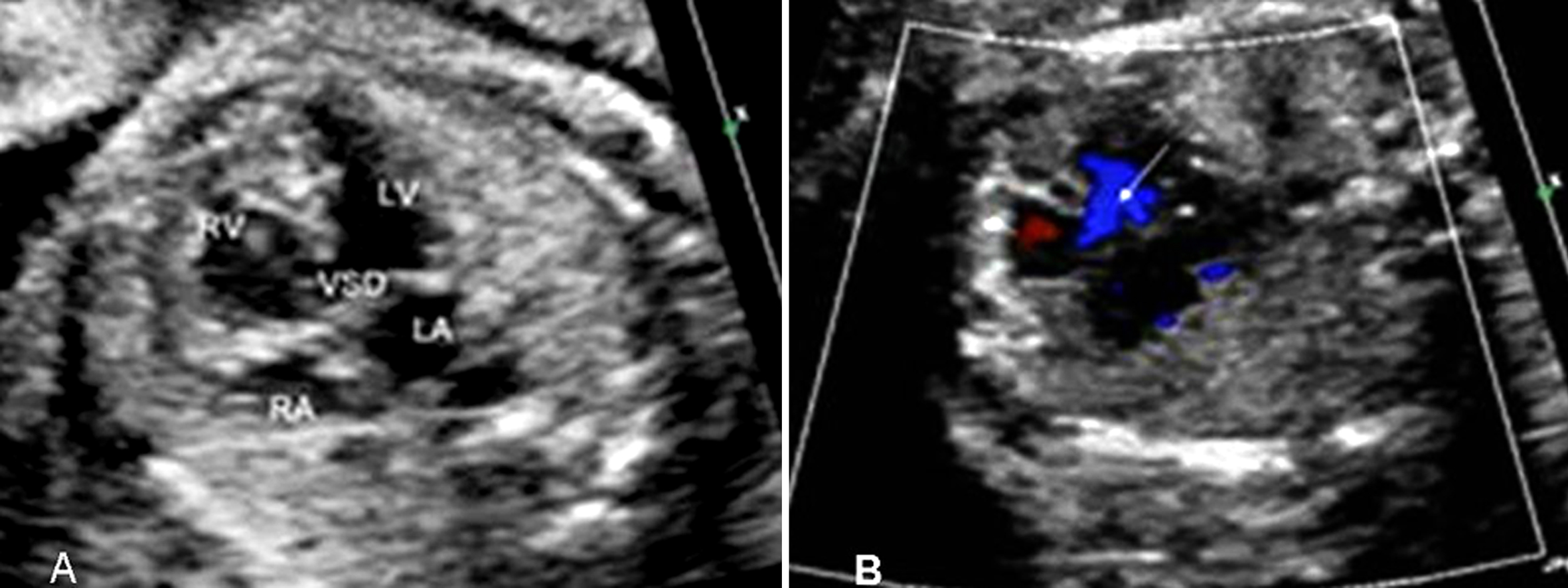 胎儿心脏发育异常微小室间隔缺损,胎儿心脏缺损1.3毫米严重吗