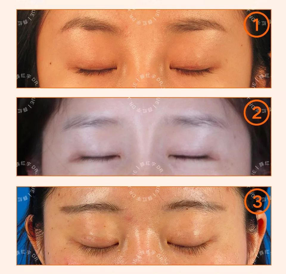 无痕双眼皮大概要多少钱,无痕双眼皮闭眼有痕