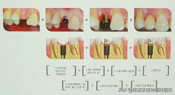 做种植牙必须要具备这些条件,种植牙的缺点哪些人不适合种植牙