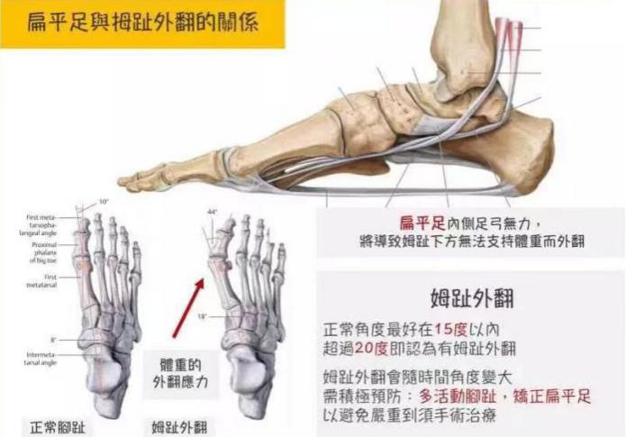 脚拇趾外翻矫正手法图解,脚拇趾外翻手术流程怎样