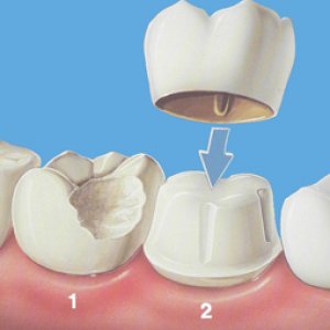 烤瓷牙崩瓷修复的详细步骤,烤瓷牙崩瓷必须更换吗