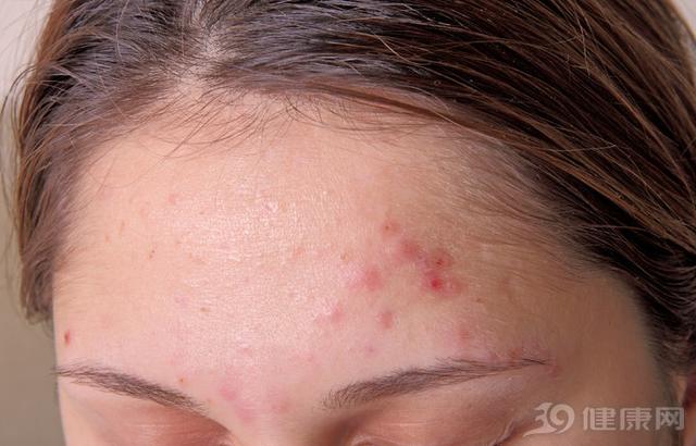 螨虫除不干净怎么办,螨虫如果不及时清理的话会怎样