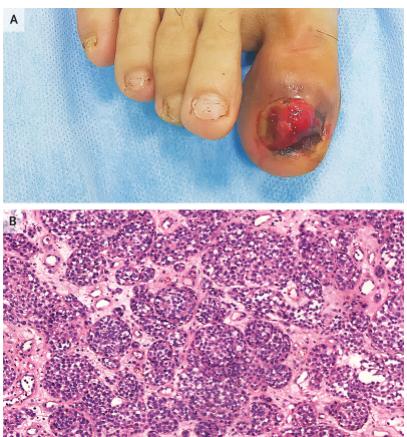 医声-有医招⑪|指甲突然变黑了?你可能得了这种病