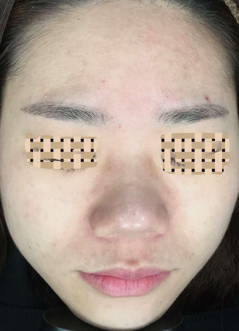 痘痘没了又长怎么解决,痘痘没了毛孔很大怎么办