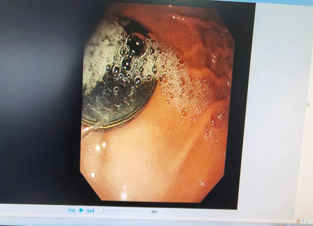 临沂两幼童被严重烧伤最新情况,临沂两个小孩上学被撞