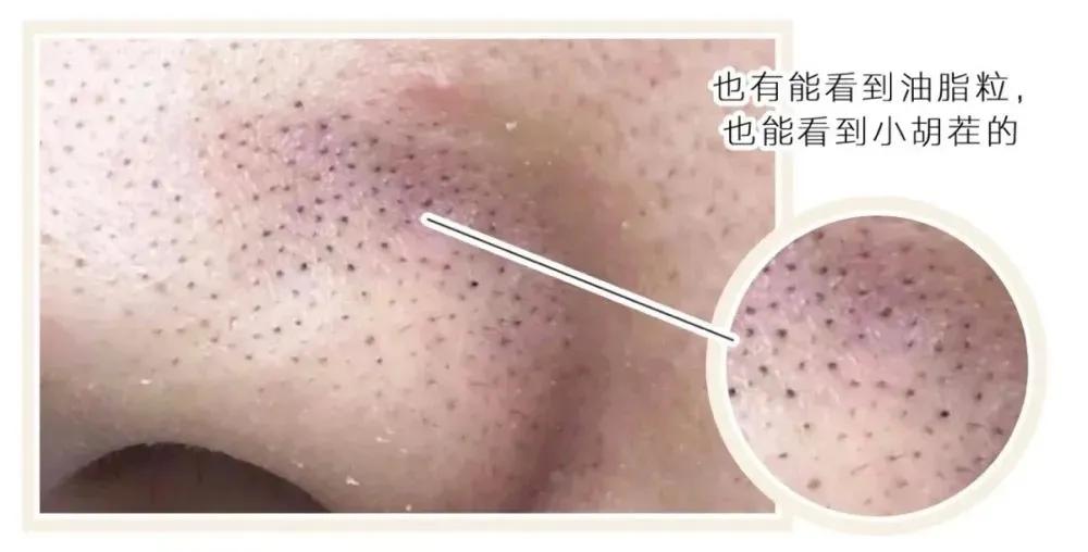 黑头用黑头贴去不掉怎么办,白糖去黑头的正确方法