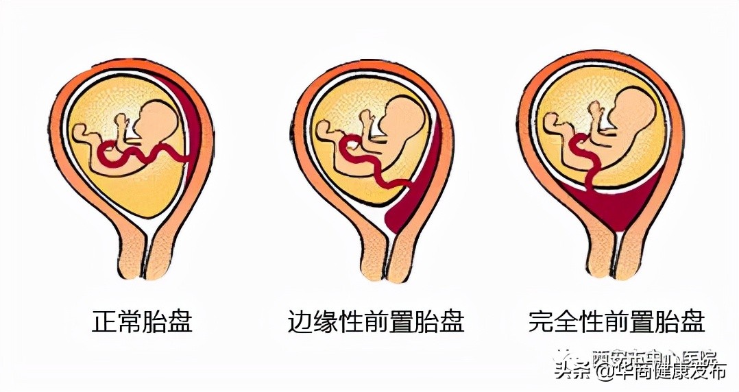 前置胎盘到底可不可怕,为何会出现前置胎盘