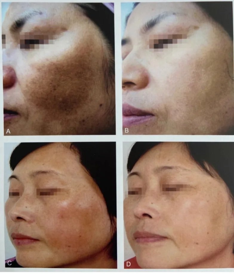 超皮秒避坑,超皮秒祛斑适合角质层薄的人