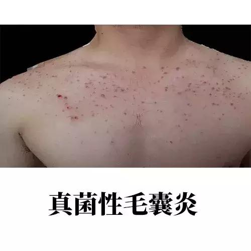 背上的青春痘,16岁背上长青春痘