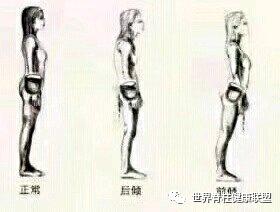 什么动作可以矫正尾骨,骶尾骨痛有哪些动作可以改善