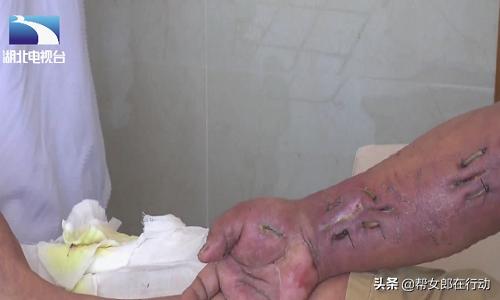 手被虾刺了一下竟然要截肢,被虾扎破手需要截肢才能保命