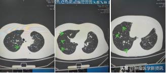 抗癌物质能治愈癌症吗,抗癌成功的几率有多大