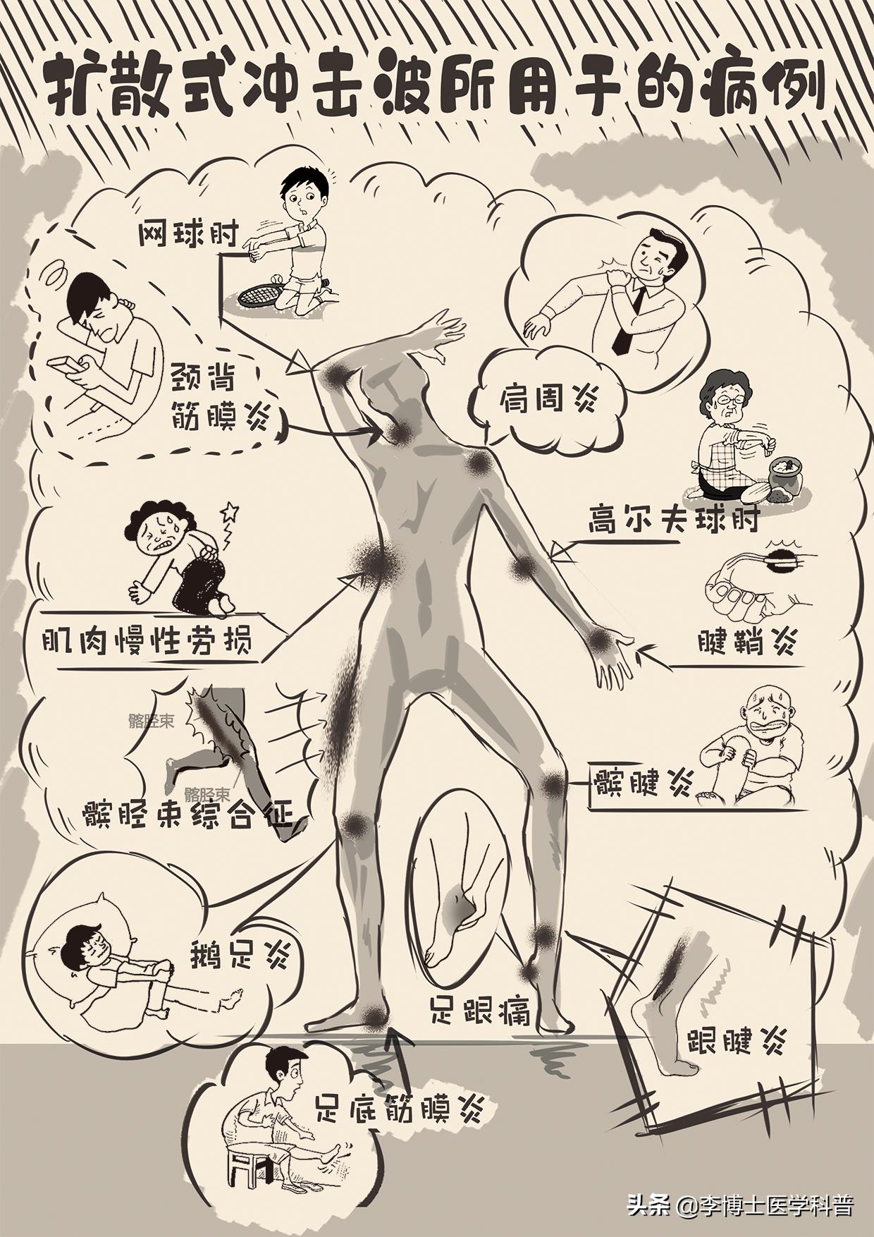 冲击波治疗脚跟骨刺有效果吗,脚后跟骨刺冲击波治疗效果怎么样