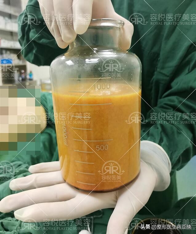 苹果肌吸脂抽出来的是血水,下额吸脂吸出来的都是血水