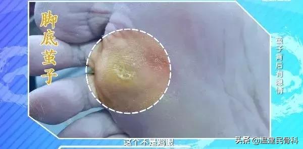 健康之路茧子,cctv10健康之路在线直播回看