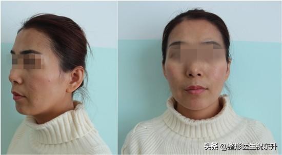 太阳穴凹陷与额头有明显棱角面相,太阳穴凹陷的脸型有长的好看的吗