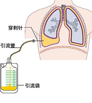 肺癌手术拔管后咳嗽严重怎么办,肺癌手术拔管后漏气有什么征兆