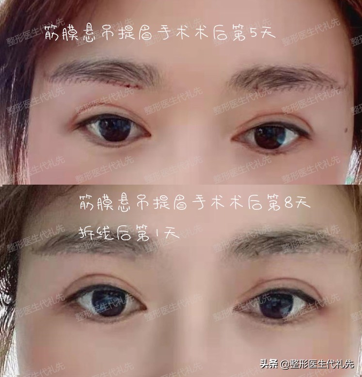 提眉最多一生能做几次提眉,提眉手术怎么操作