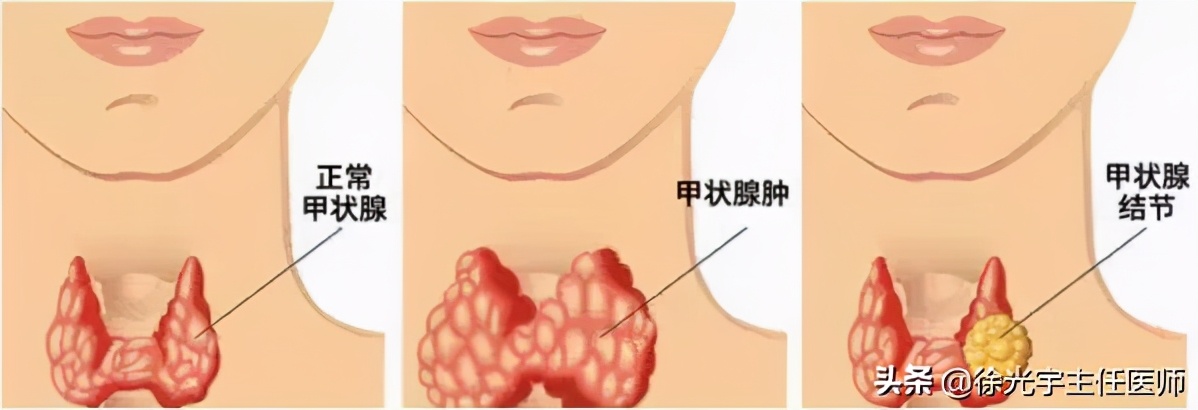 甲状腺结节问题不能被忽视,有甲状腺结节最不应该吃的是什么