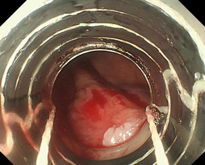 做肠镜喝泻药痔疮出来了怎么办,肠镜检查发现有痔疮可以切掉吗