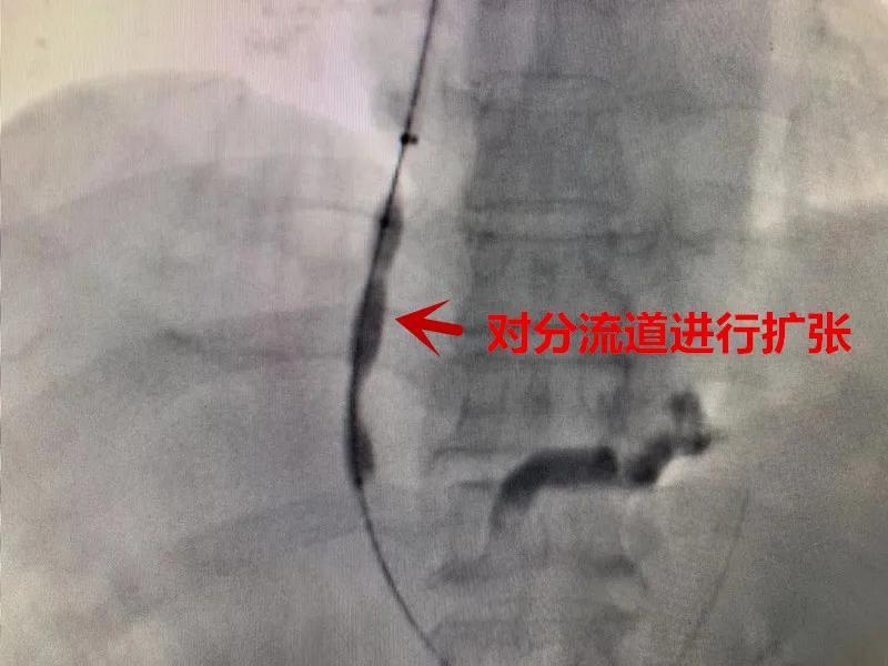 肝硬化门脉高压物理治疗方法,肝硬化失代偿期门脉高压