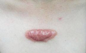 瘢痕疙瘩与什么病相似,瘢痕疙瘩跟脓包区别