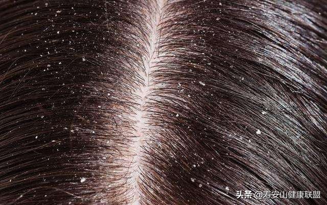 被顽固头屑缠上的四大理由，最后一个你绝对想不到