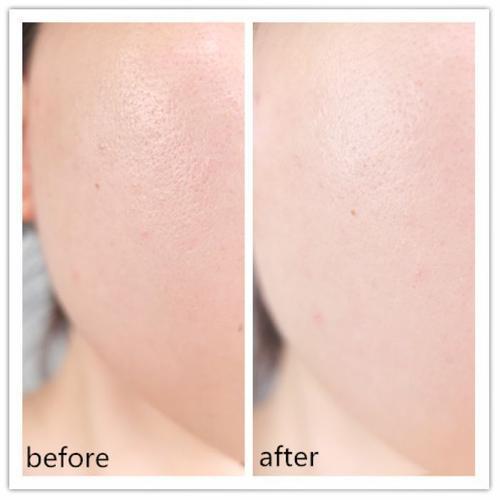 今天治疗，明天上班，激光中的“法拉利”超皮秒