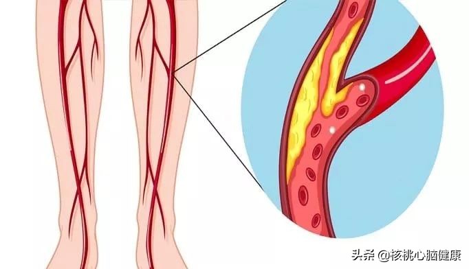引起下肢动脉硬化原因是什么,下肢动脉硬化疼痛如何缓解