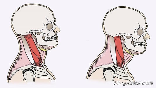 颈后鼓包动作,颈后大包如何处理