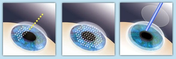 近视眼手术晶体移植和激光的区别,近视眼做了激光有什么利弊