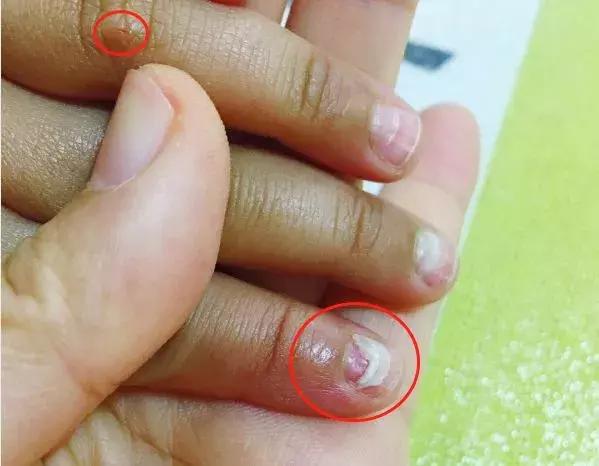 手足口喝利巴韦林管用吗,利巴韦林可以治手足口吗