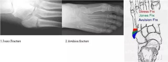 所有骨折都叫什么名字,骨折的名称有哪些