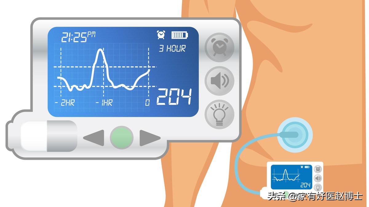有没有人工智能胰岛素泵,人工胰岛素泵