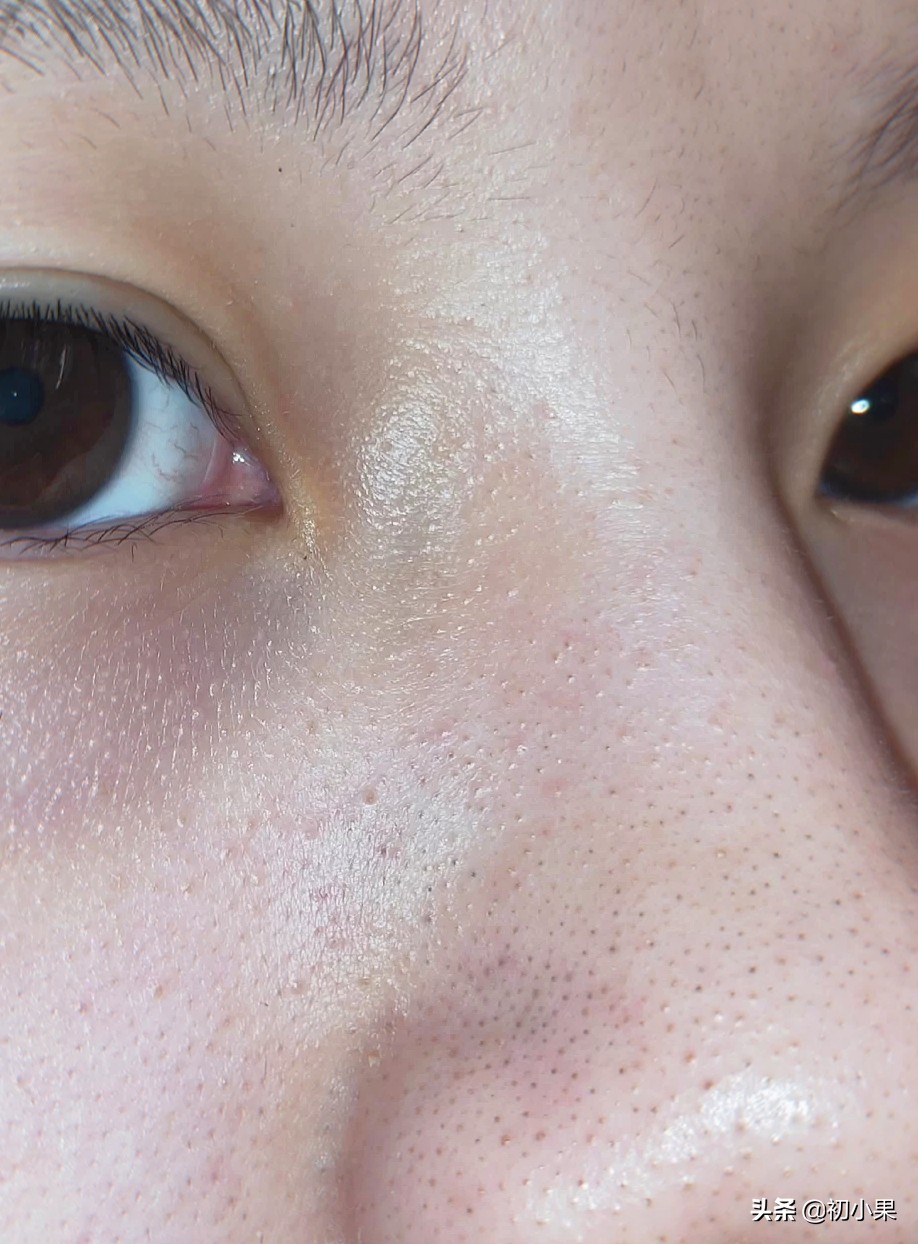 鼻子上的黑头怎么去除,鼻子上的黑头怎么去除儿童