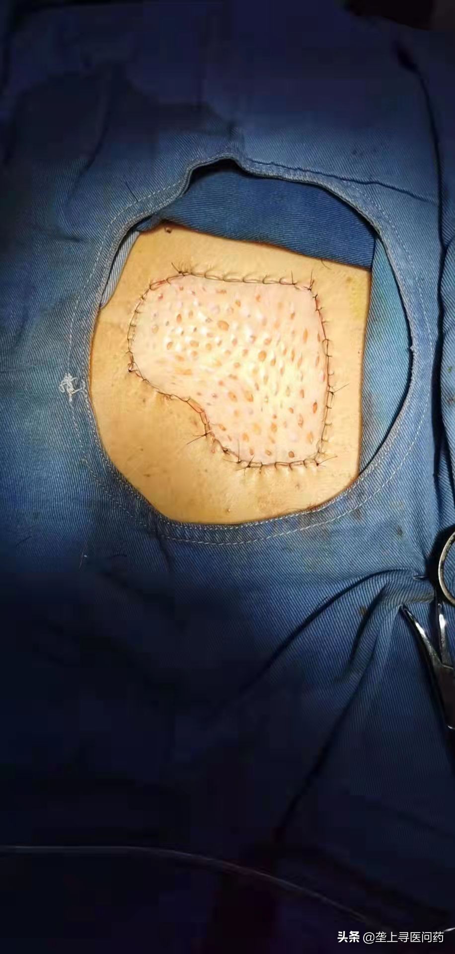 前胸口疤痕修补,小伙胸口疤痕疙瘩切除