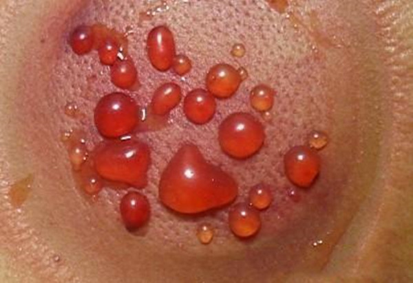 拔火罐有水泡是湿气重吗,拔火罐拔出水泡然后烂了