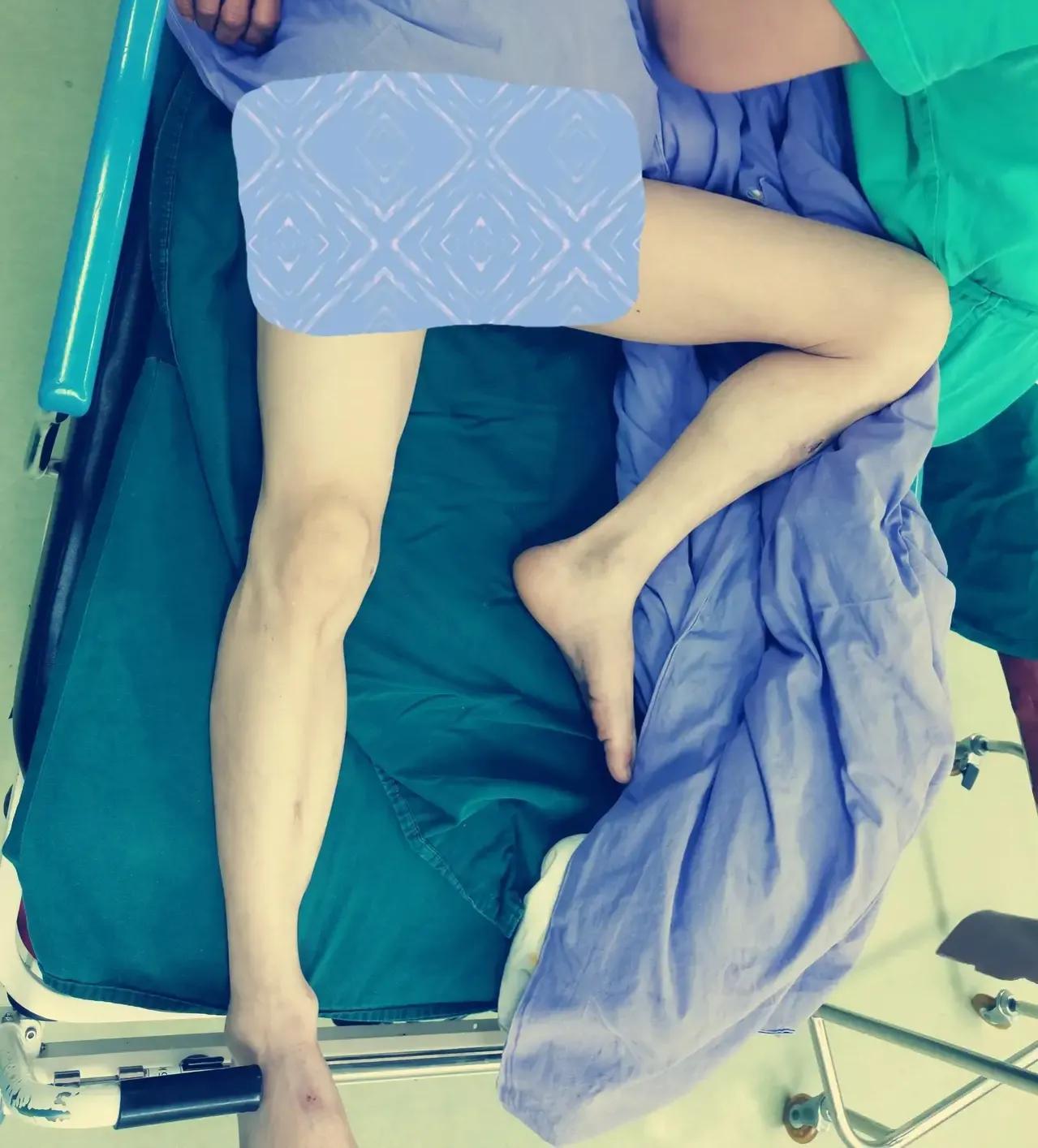 犬髋关节脱位闭合复位,髋关节脱位的闭合复位