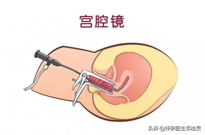 子宫内膜厚为什么医生都建议刮宫,子宫内膜厚刮宫什么时候去做最好