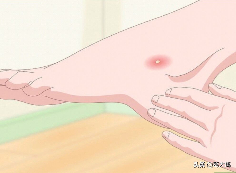 夏季如何辩认跳蚤的咬痕