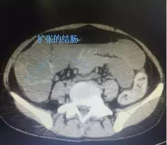 市八医肛肠外科开展腹腔镜下次全大肠切除术治愈慢性便秘患者
